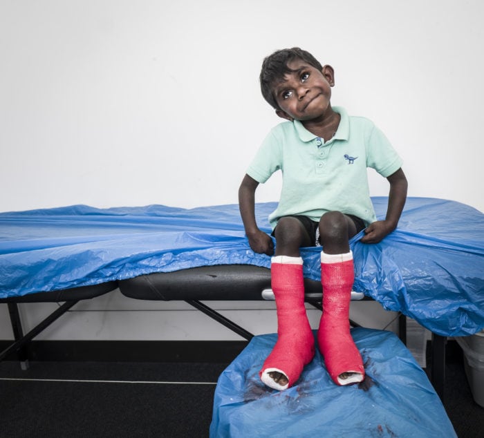 A young boy sits on a medical bed with red serial casts on, he smiles. 