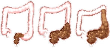 Diagram of constipation in the bowel