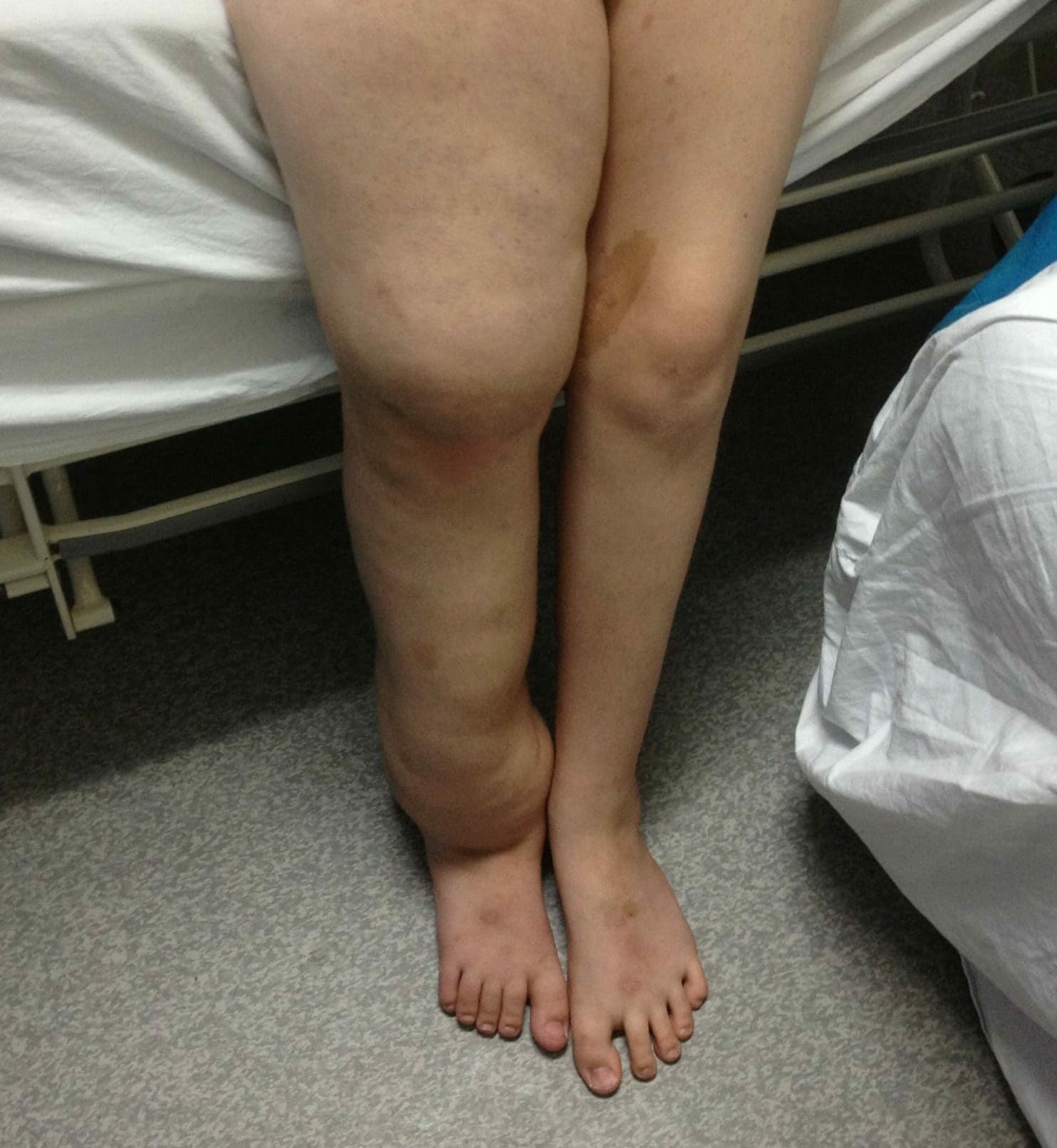 A pair of legs lean against a hospital bed. The right leg is extremely swollen and the left leg is of normal size.